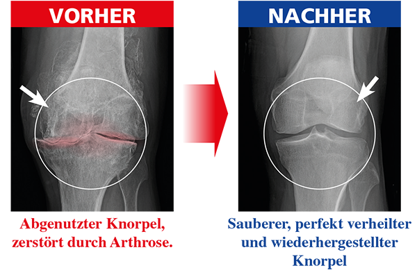 arthrose